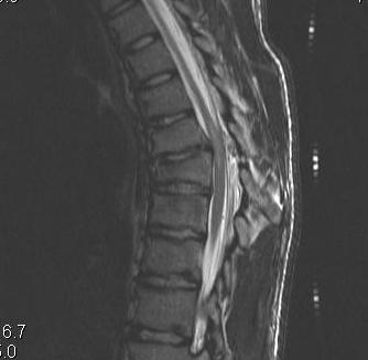 Thoracic Burst MRI Sagittal Kyphosis and Cord Signal